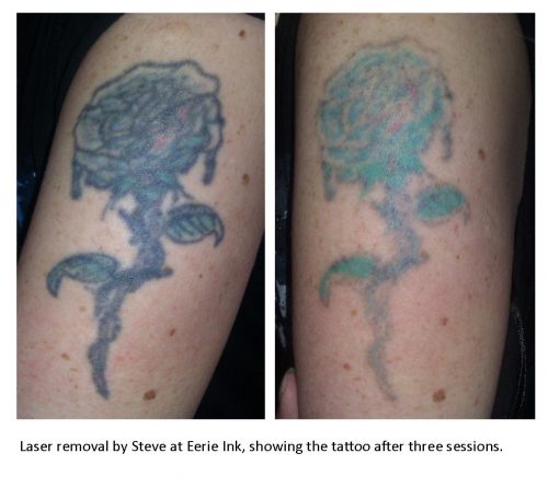 quitar tatuaje con laser (9)